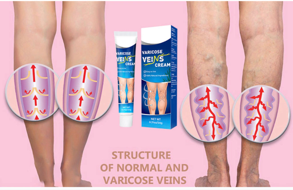 Crema Para Varices Piernas Perfectas Salud Mejora Apariencia