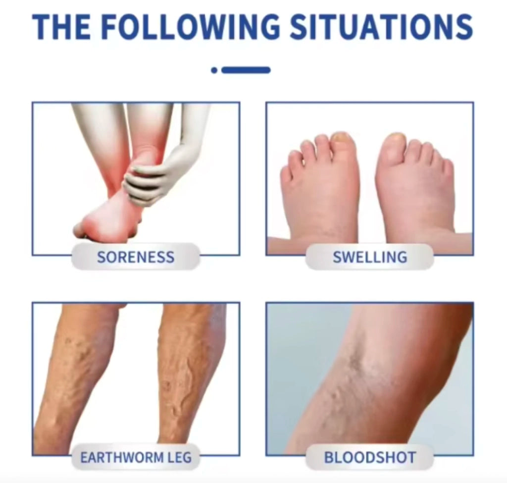 Crema Para Varices Piernas Perfectas Salud Mejora Apariencia