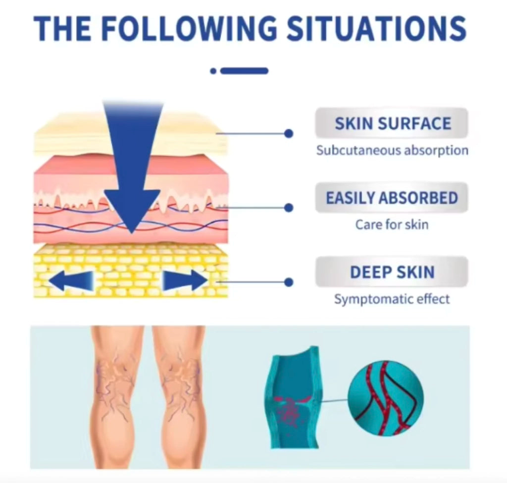 Crema Para Varices Piernas Perfectas Salud Mejora Apariencia